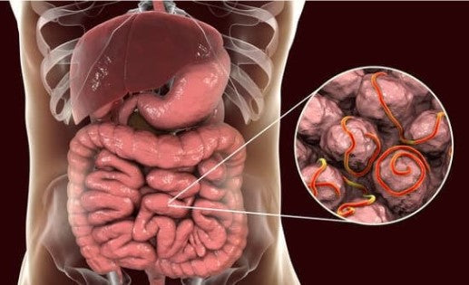 Medical illustration of the human digestive system with a magnified view showing intestinal parasites and worms inside the gut.
